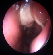 Fig. 1. Nasal endoscopy – middle turbinate purulent secretions