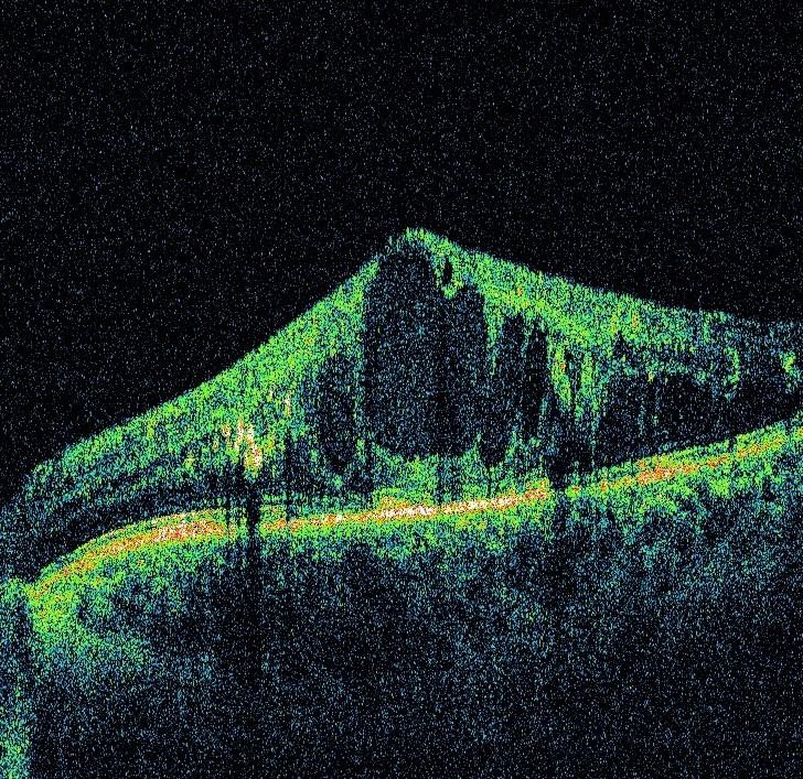 Fig. 1. SDOCT image of DME with DRIL – boundaries between inner retinal layers cannot be identified