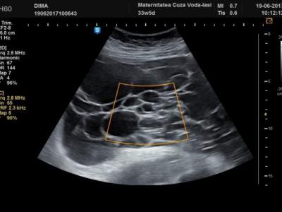 Ovarian tumors